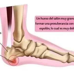 Par Plantillas Pie Cavo/plano Ortopédicas Ajustables Espolón